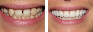 Реставрация зубов: как найти надежную клинику